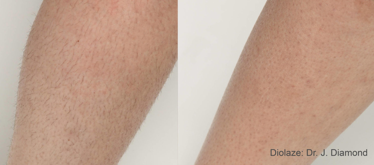 Laser Hair Removal Diolaze 2a 2tx 2months 1st and 2nd 30J strongcooling shortpulse 3 e1592863337156