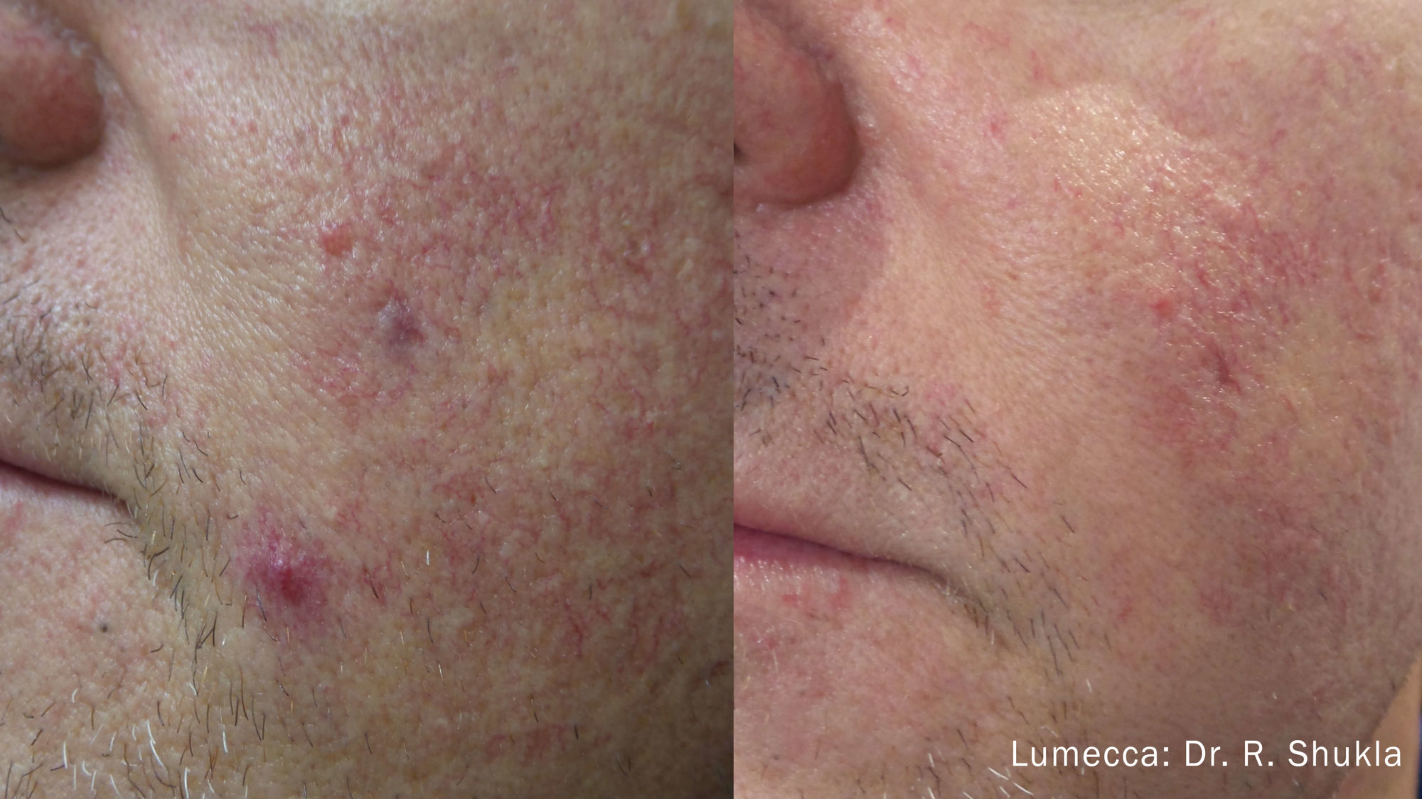 Skin Rejuvenation RS Lumecca 3a 3tx 1 e1592863416855
