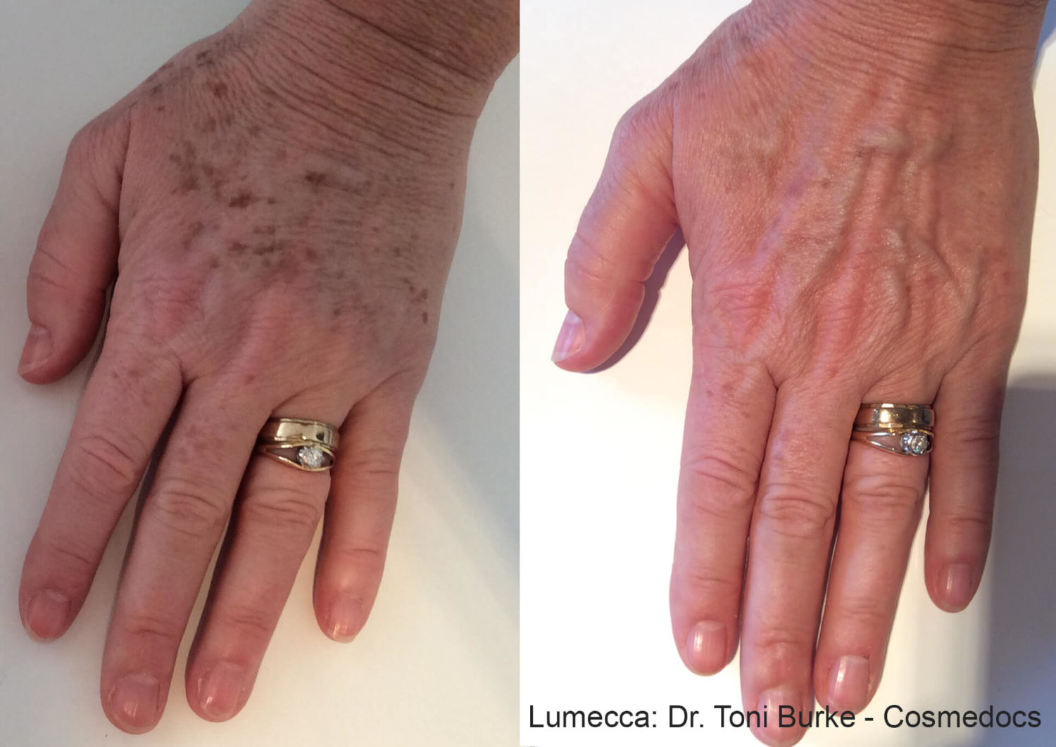 Skin Rejuvenation TB Lumecca 1a Hands 1 e1592863397462